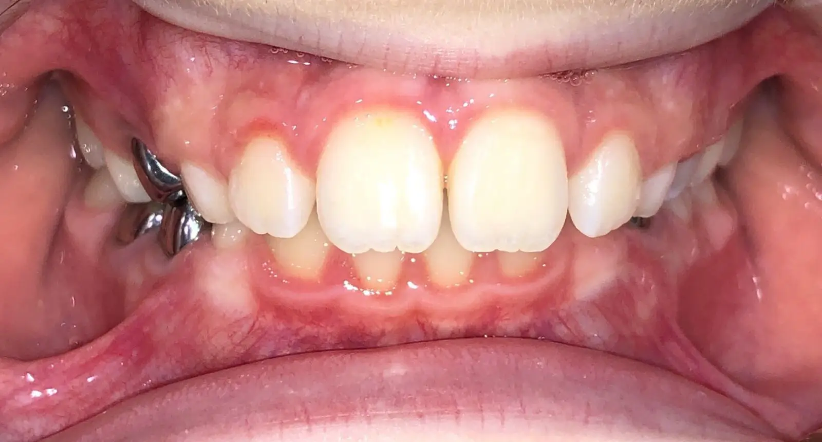 img-Early-or-Interceptive-Treatment-pic-13 1