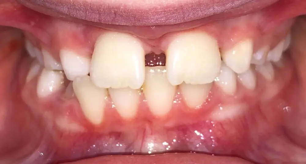 img-Early-or-Interceptive-Treatment-pic-7