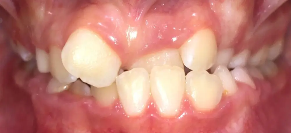 img-Early-or-Interceptive-Treatment-pic-9
